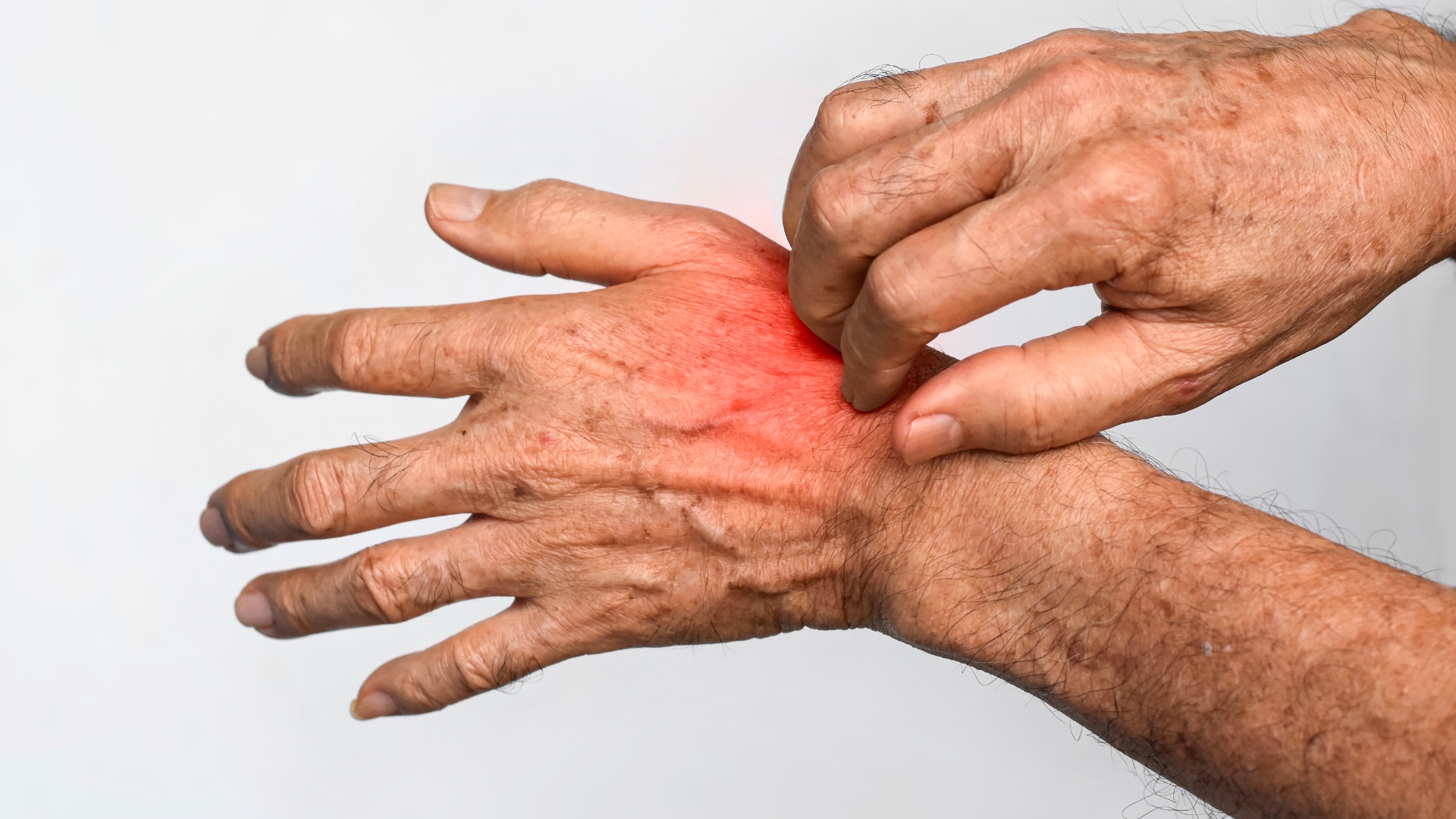 Itchy red skin on hand showing symptoms of scabies or skin irritation treated with ivermectin in Australia