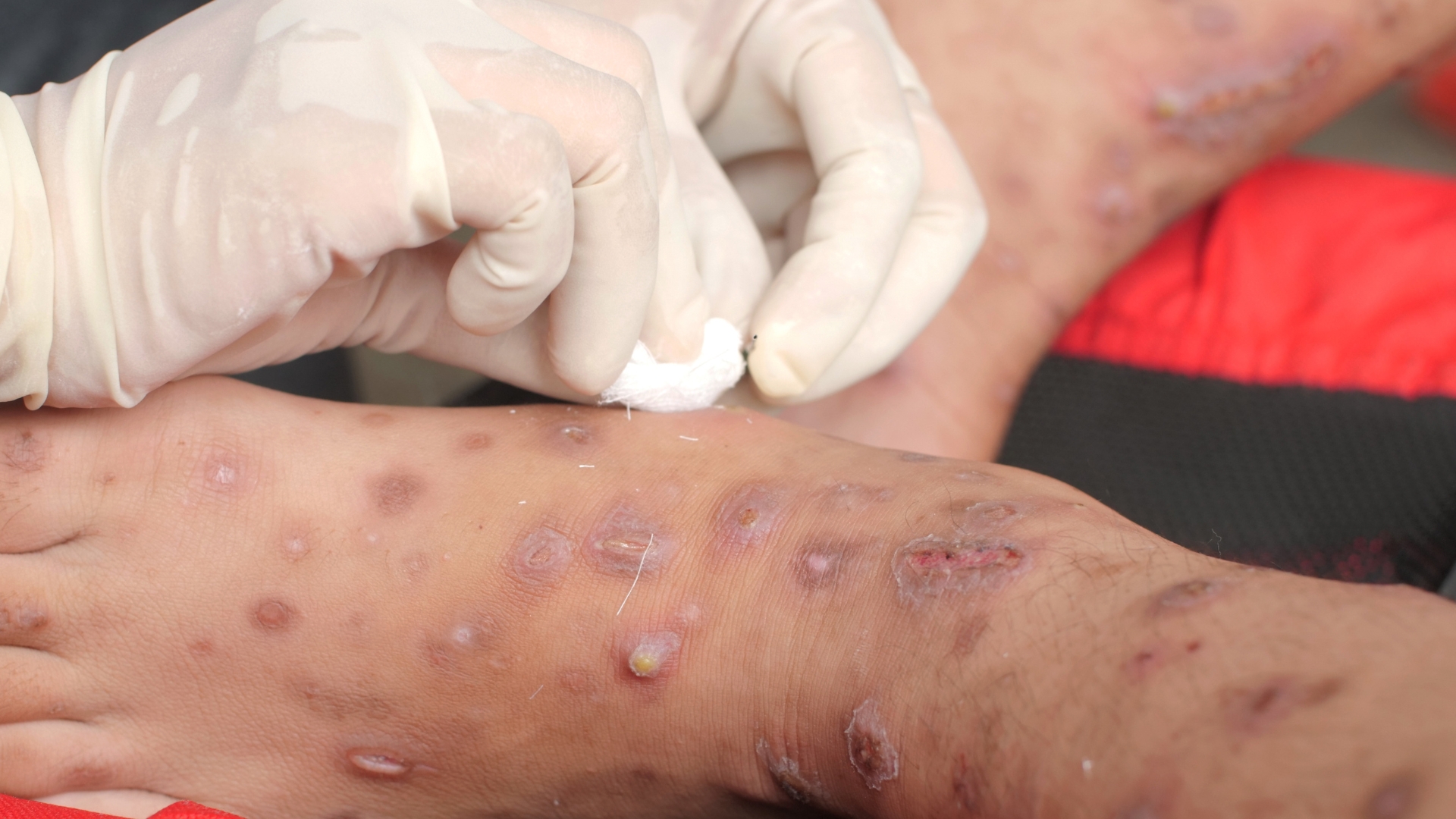Medical professional treating severe scabies skin rash on a patient's foot, a condition commonly managed with oral ivermectin treatment in Australia.