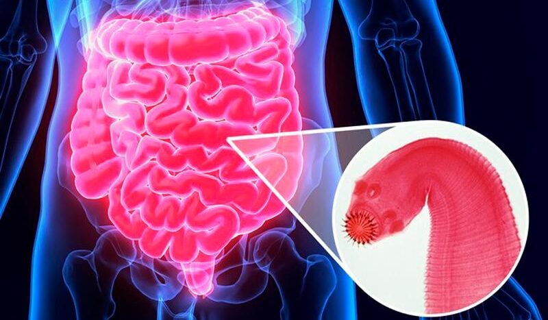 Tapeworm infection in the human intestine showing an intestinal parasite